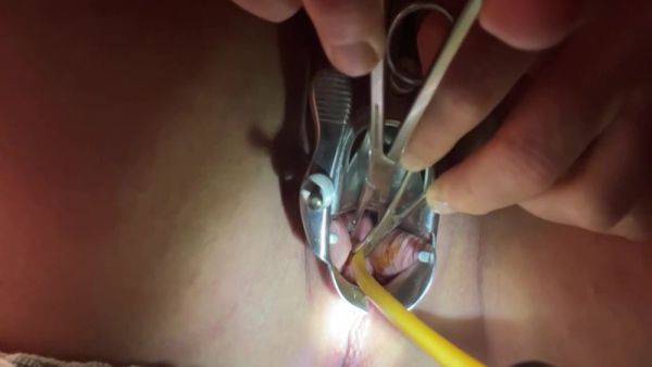 Tenaculum Grasping Cervix For Catheter 7 Min - hclips.com on poweredporn.com