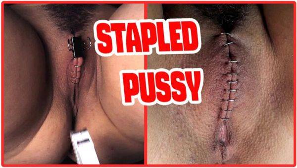 Sadistic Doctor Staples Teen Goth Girl's Hairy Pussy in Extreme BDSM Medical Punishment - veryfreeporn.com - Spain on poweredporn.com